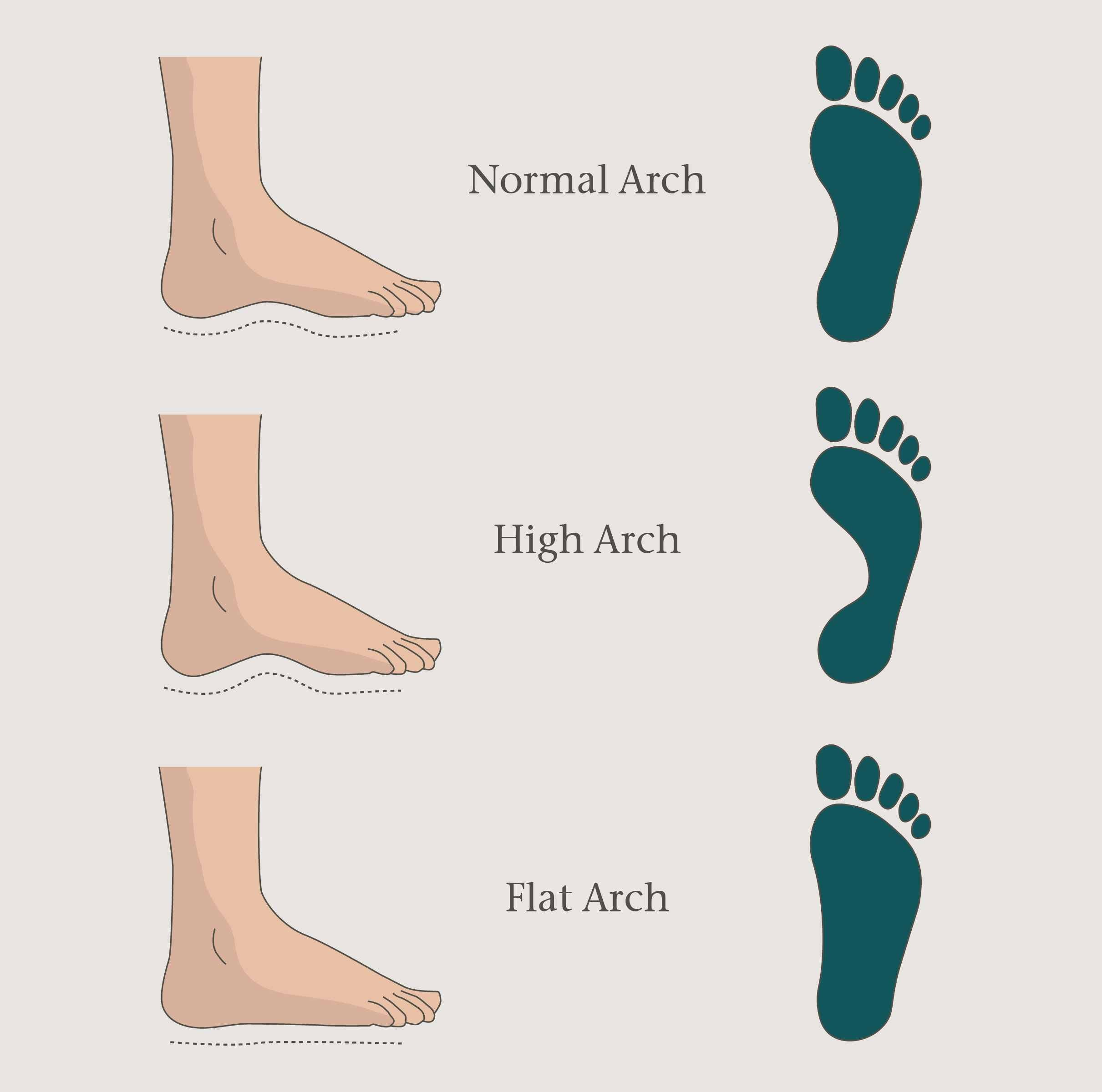 feet arch types
